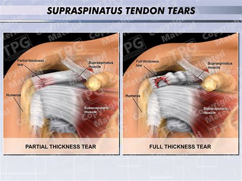 tests for supraspinatus tear|complete full thickness supraspinatus tear.